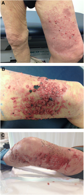 Dr. BHB - help me diagnose this rash