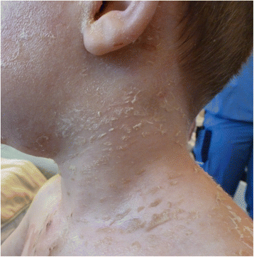 Staphylococcal scaldeWd skin syndrome and toxic shock syndrome.