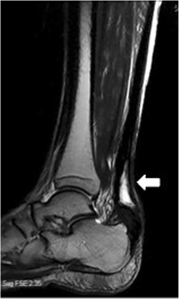 Reconstruction of a chronically ruptured Achilles tendon using an