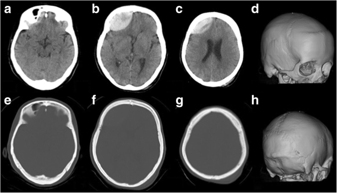 Acute contrecoup epidural hematoma that developed without skull fracture in  two adults: two case reports | Journal of Medical Case Reports | Full Text