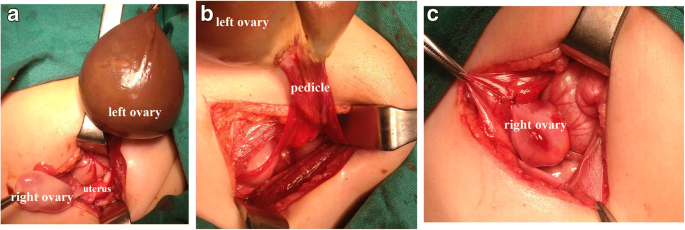 Laparoscopic Oophorectomy for Ovarian Torsion • Video •