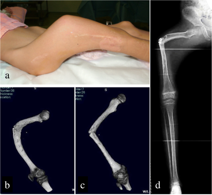Pronounced femur malunion after pathological bone fracture due to a simple  bone cyst in the shaft of the femur, treated using Ilizarov fixation: a  case report | Journal of Medical Case Reports |