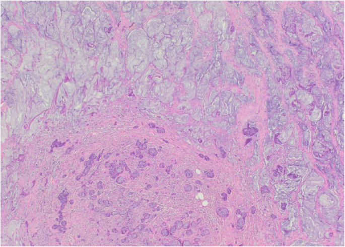 Biopsy-based diagnosis of signet-ring cell adenocarcino | Open-i