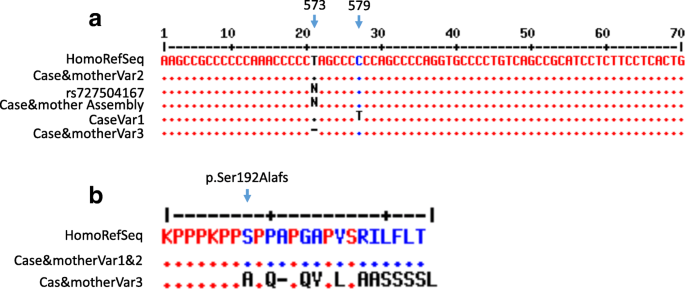 Niemann-Pick disease A or B in four pediatric patients and SMPD1