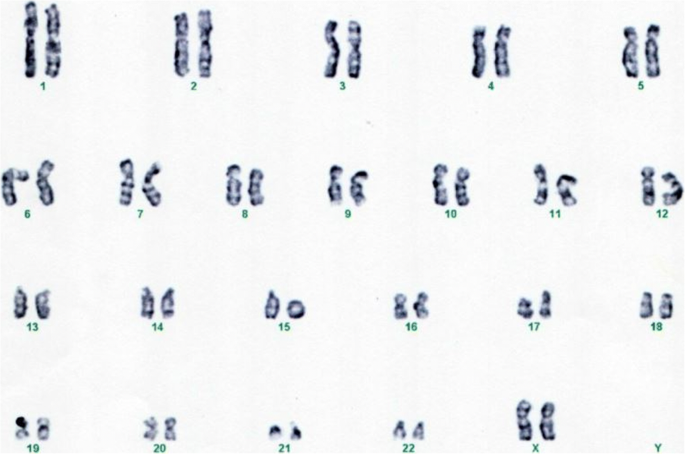 Chromosomes and Chromosomal Abnormalities | Neupsy Key