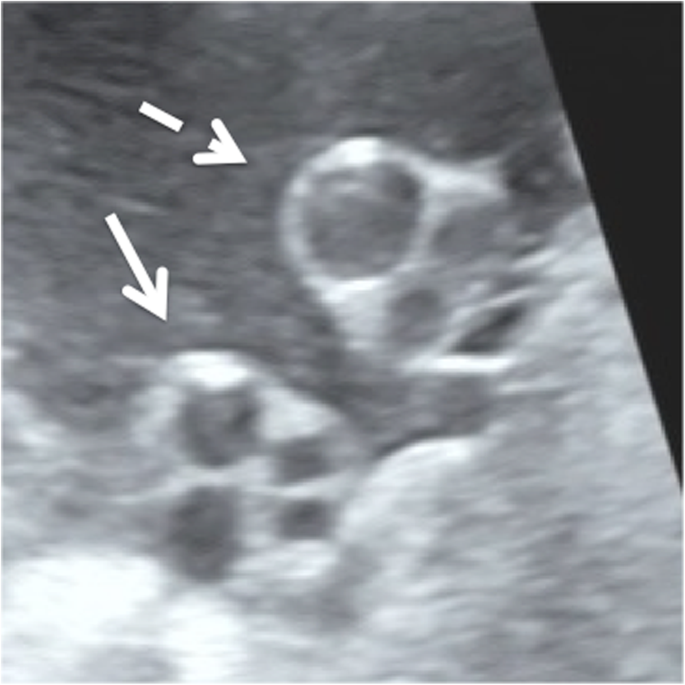 A partial supernumerary umbilical vein: a case report | Journal of Medical  Case Reports | Full Text
