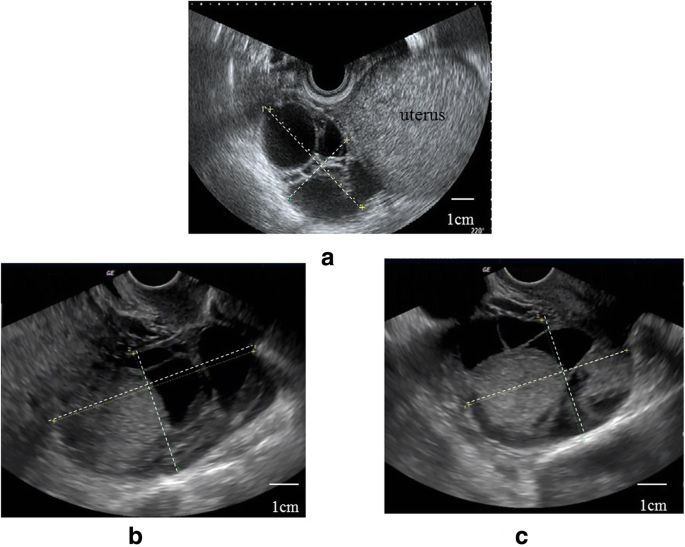 Ovarian hyperstimulation syndrome following surgical removal of a complete  hydatidiform mole: a case report | Journal of Medical Case Reports