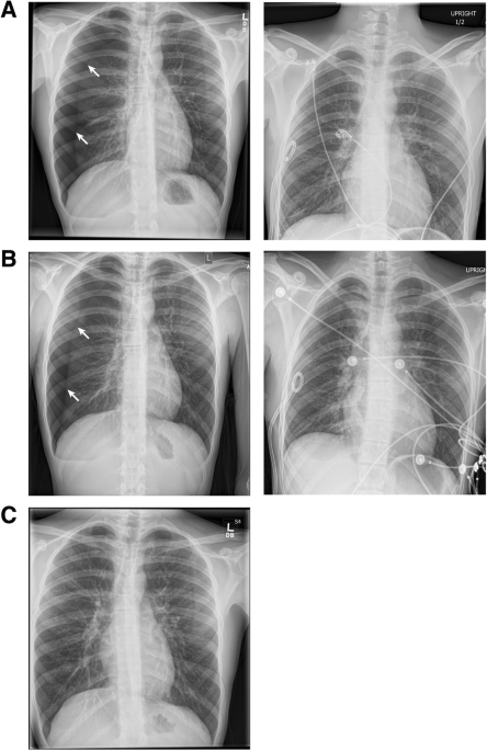 Recurrent spontaneous pneumothoraces and vaping in an 18-year-old man: a  case report and review of the literature | Journal of Medical Case Reports 