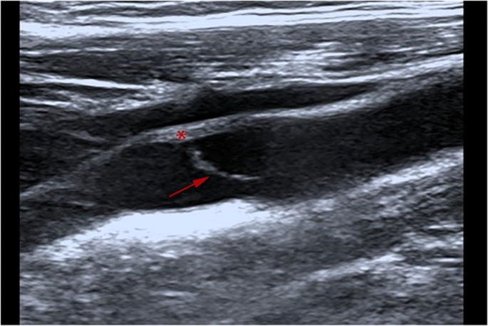Ultrasound imaging of carotid web with atherosclerosis plaque: a case  report | Journal of Medical Case Reports | Full Text