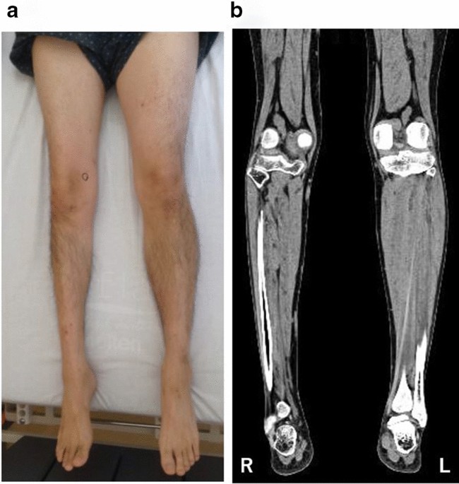 Unilateral lower limb atrophy associated with glomus tumors: a case report  | Journal of Medical Case Reports | Full Text