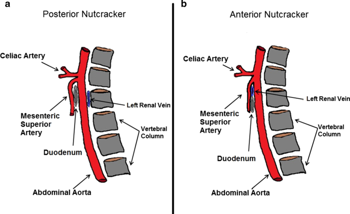 Posterior nutcracker syndrome: a case report | Journal of Medical Case  Reports | Full Text