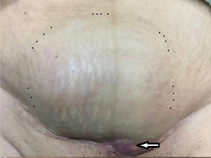 Photograph of the left corner of the cesarean section scar showing