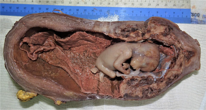 Placenta increta presenting with threatened miscarriage during the first  trimester in rhesus-negative mother: a case report | Journal of Medical  Case Reports | Full Text