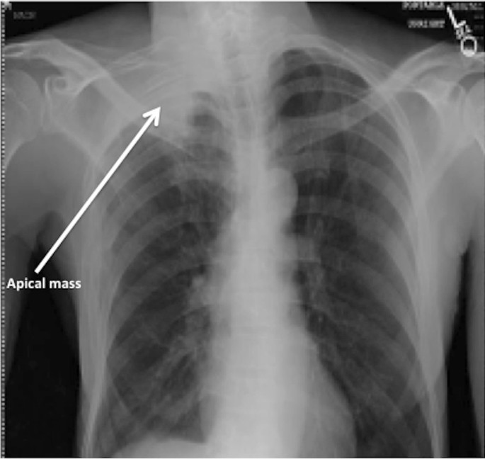 Pancoast tumor presenting with multiple joint pains: a case report |  Journal of Medical Case Reports | Full Text