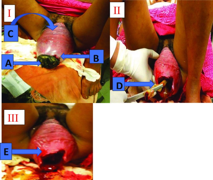 Uterovaginal prolapse in a primigravida presenting in active first