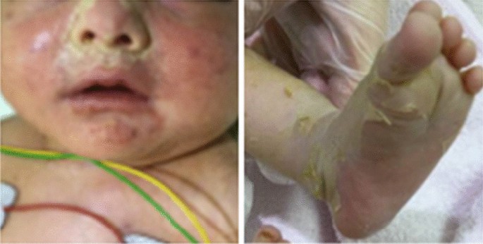 Gaucher disease carrier with gestational thrombocytopenia and anemia-Homeopathic Treatment-Best Homeopathic doctor-Pakistan-Dr Qaisar Ahmed-Al Haytham clinic-Risalpur-KPK