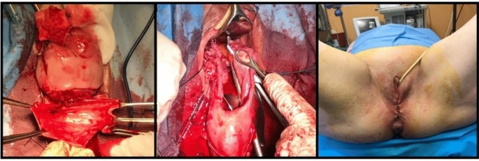 Stasis ulcer and hydronephrosis after severe genital prolapse: a
