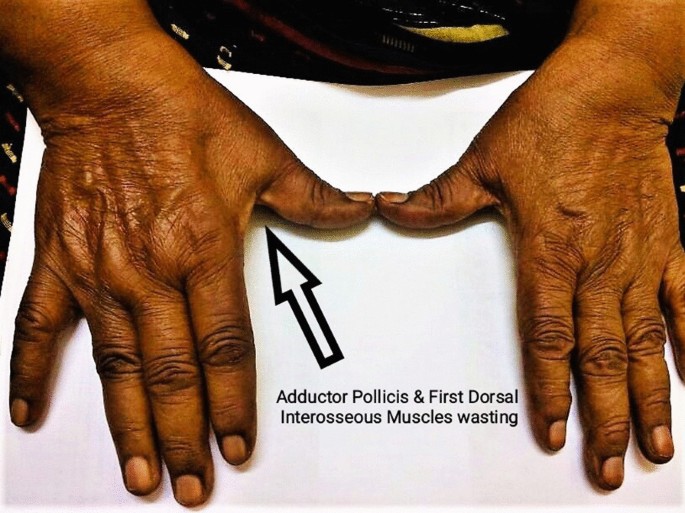 Cubital tunnel syndrome of the ulnar nerve caused by an epineural