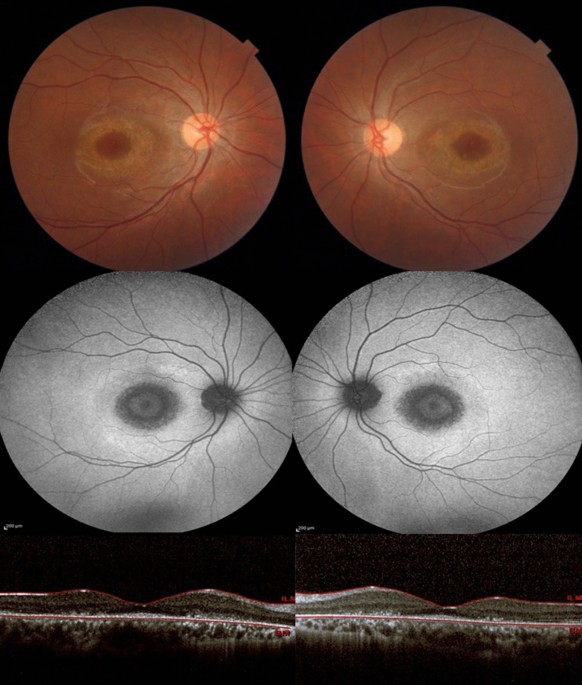 Presumed veterinary niclosamide-induced retinal toxicity in a human: a case report