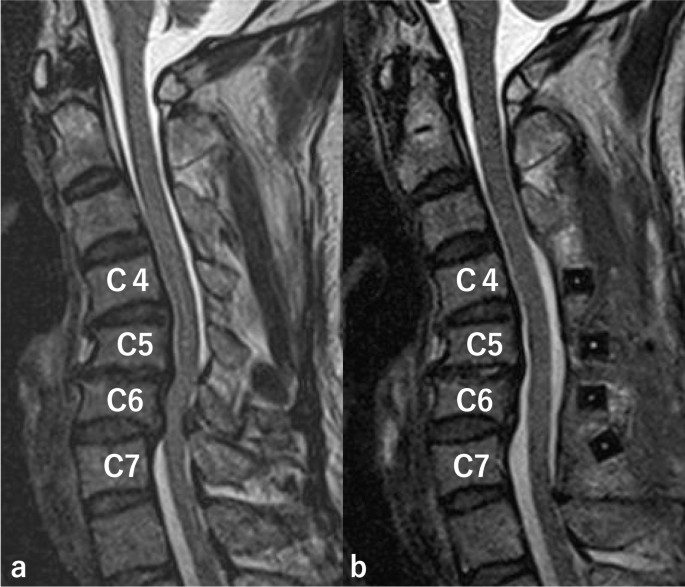 bpc 157 spinal stenosis Decompression for lumbar spinal stenosis at the intrathecal catheter  insertion site during intrathecal baclofen therapy: a case report | Journal  of Medical Case Reports