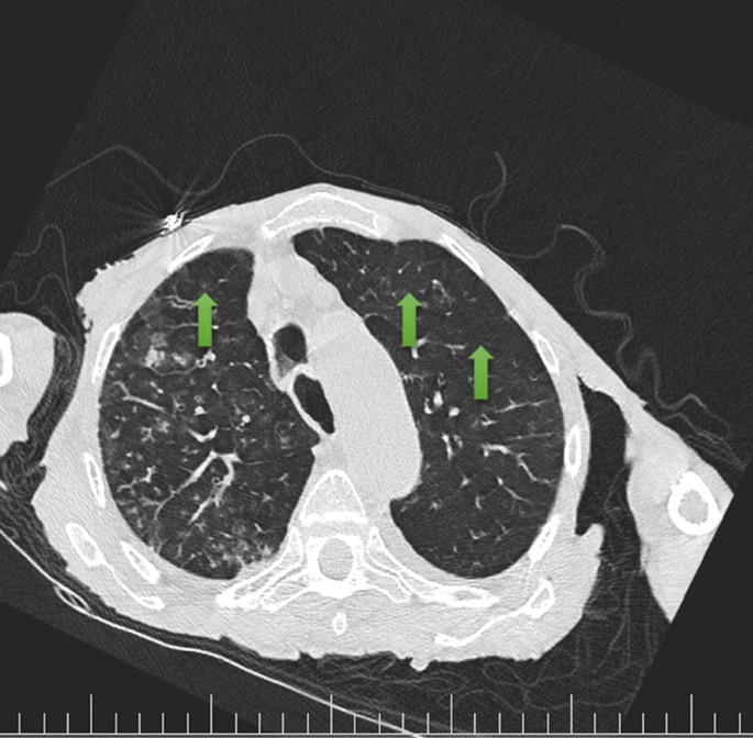 Late diagnosis of respiratory syncytial virus and influenza co-infection during coronavirus disease 2019 pandemic: a case report
