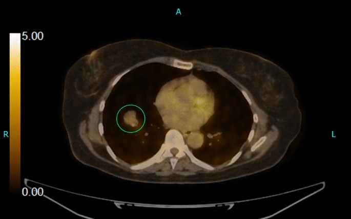 vulvar melanotic macule Melanosis on the labia minora showing a parallel pattern (uniform