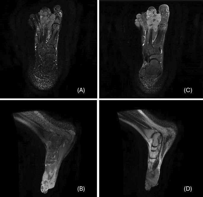 Navigating diagnostic challenges—distinguishing malignant melanoma and  clear cell sarcoma of soft tissues: a case report and review of the  literature | Journal of Medical Case Reports
