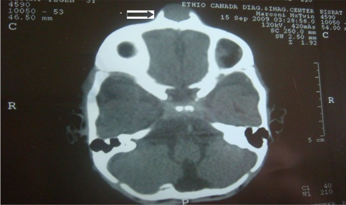 Melanotic neuroectodermal tumor of infancy: a case report | Journal of  Medical Case Reports