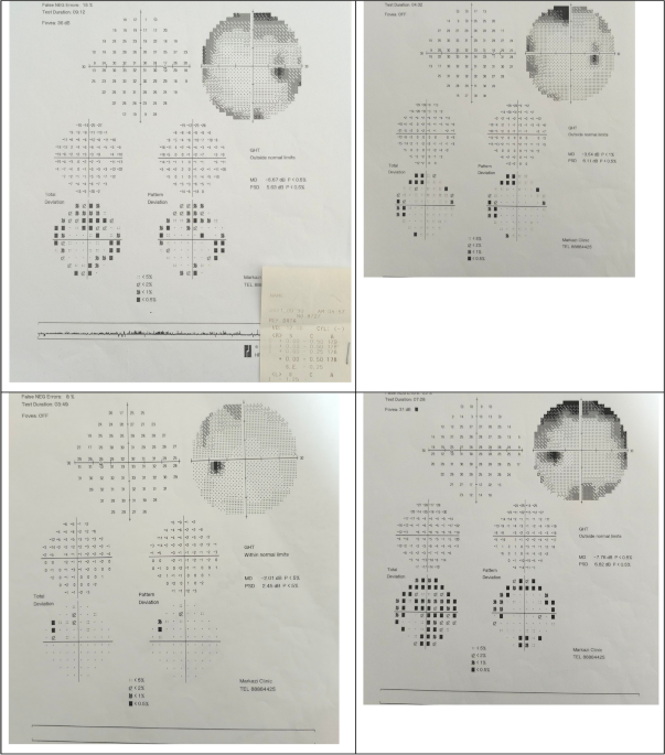 A long-standing undiagnosed case of vitamin B12 deficiency: a case report |  Journal of Medical Case Reports