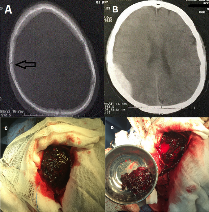 dihexa traumatic brain injury Talk and die” syndrome, a tragedy in injury: a cohort study | Journal of Medical Case Reports 54955 Pack Size:3 Vials how often to use