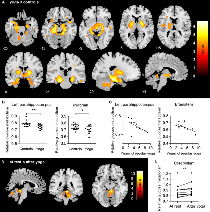 Long-term Ashtanga yoga practice decreases medial temporal and