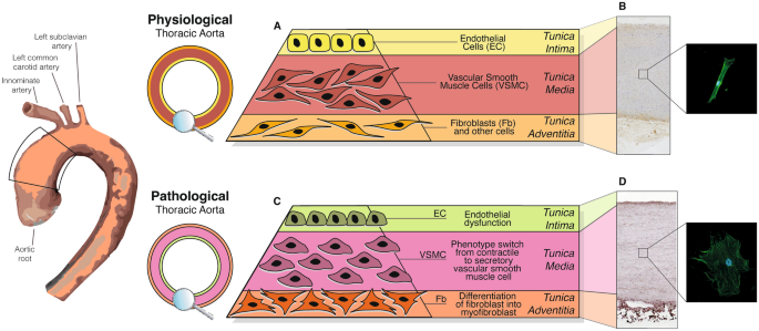 Molecular Mechanisms in Genetic Aortopathy–Signaling Pathways and Potential  Interventions