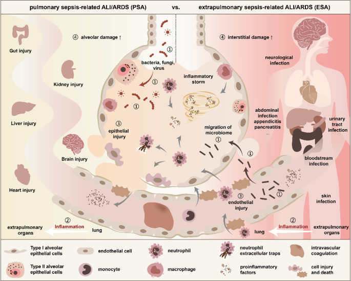 pneumonia complications in elderly lungs sepsis ARDS pleural effusion medical illustration