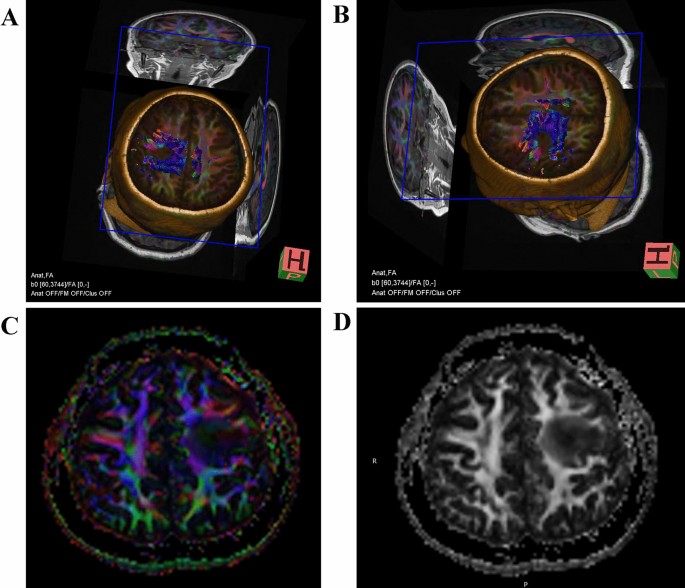 Novel method using DW-MRI and ADC images to guide stereotactic biopsy for  the diagnosis small primary angiitis of the central nervous system: a case  report, European Journal of Medical Research