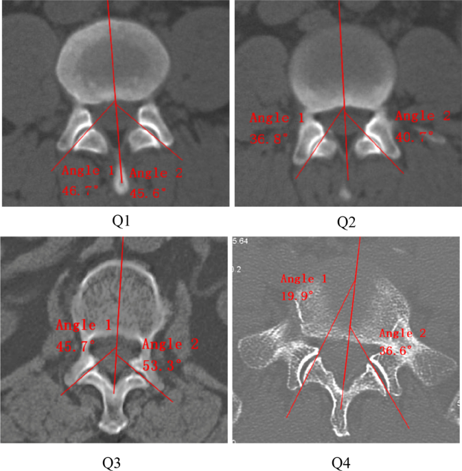 What is Degenerative Disc Disease? - RAI