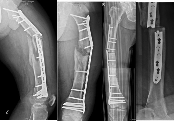 How cross screw length influences the stiffness of intrame-dullary nail  systems