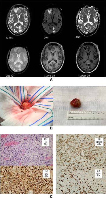 Frontiers | Case report: Cryptogenic giant brain abscess caused by  Providencia rettgeri mimicking stroke and tumor in a patient with impaired  immunity