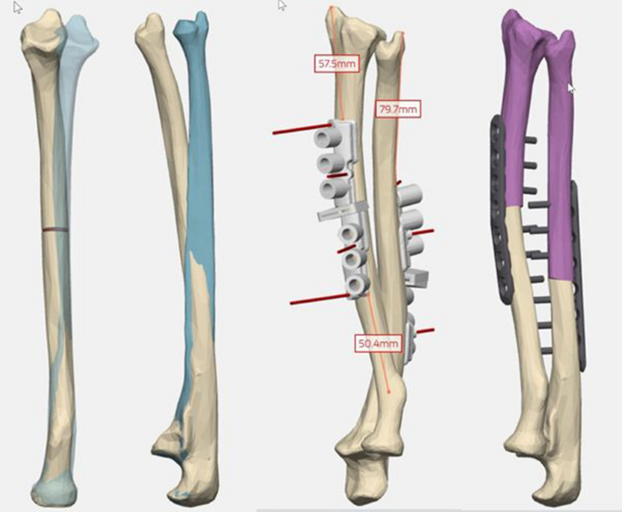 Revista Brasileira de Ortopedia - Treatment of Distal Radio Vicious  Consolidation: Corrective Osteotomy Through 3D Printing  Prototyping<sup>*</sup>