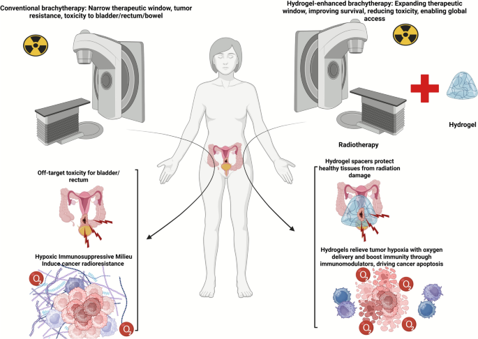 glutathione rectal implant Hydrogel-enhanced brachytherapy in cervical cancer: redefining precision, efficacy, and safety | European Journal of Medical Research Magnetic Hydrogels as a Treatment