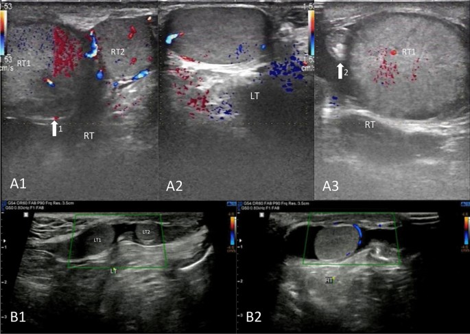 Beyond triorchidism: diagnostic pitfalls and an evidence-driven algorithm for pediatric supernumerary testes