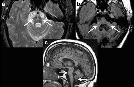 Imaging biomarkers in Parkinson's disease and Parkinsonian