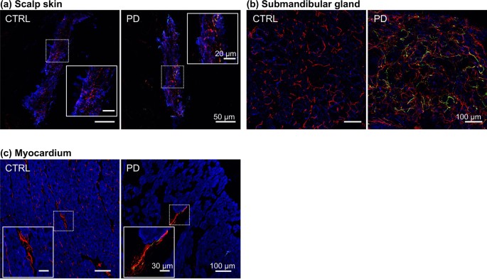 Pathophysiological significance of increased α-synuclein deposition in sympathetic nerves in Parkinson’s disease: a post-mortem observational study