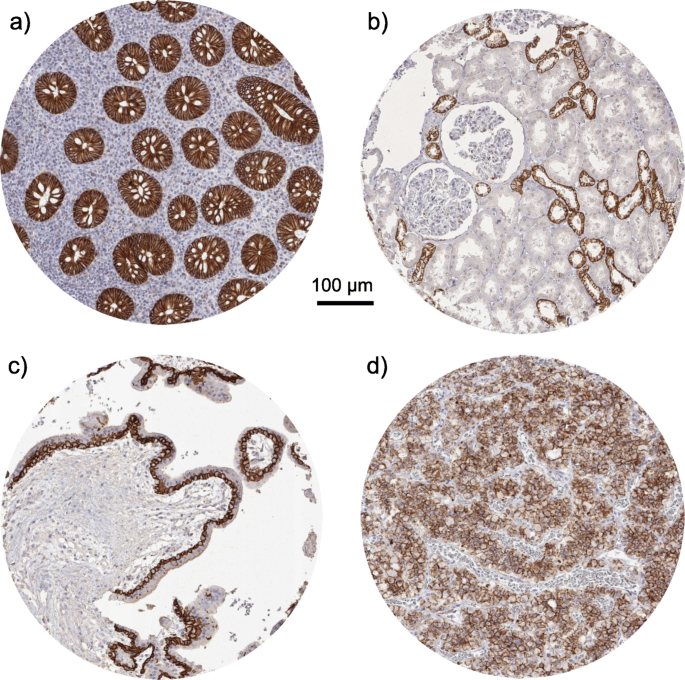 alteration in e-cadherin beta-catenin expression in canine melanotic tumors (a-d) and -Catenin expression (a1-d1) E-Cadherin expression in human tumors: