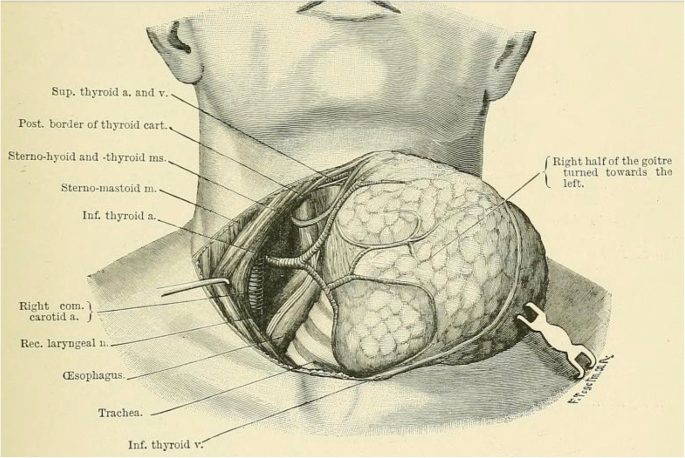 Surgical anatomy of the external branch of the superior laryngeal