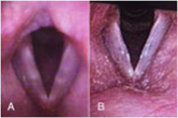 The role of steroid injection for vocal folds lesions in professional voice  users | Journal of Otolaryngology - Head & Neck Surgery | Full Text