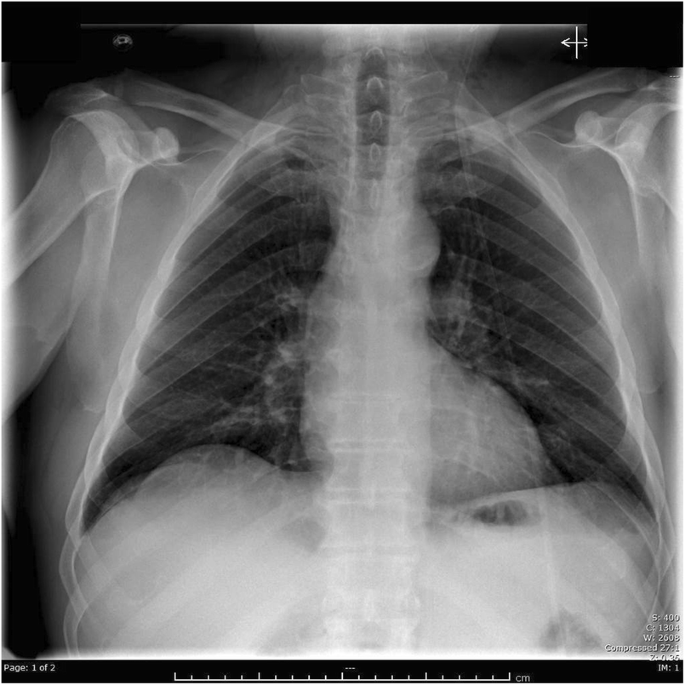 Investigation of the Electric Handpiece-related Pneumomediastinum and  Cervicofacial Subcutaneous Emphysema in Third Molar Surgery