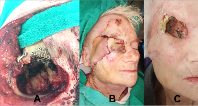 Composite submental flaps in facial reconstructive surgery involving the  zygoma and orbit | Journal of Otolaryngology - Head & Neck Surgery | Full  Text
