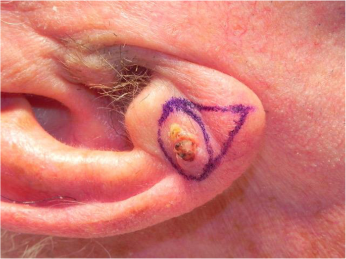 Advanced Homoeo Clinic - Are You Worried about Elongated Ear Lobe??? Do'nt  Worry, Here is a Non-surgical Ear Hole Repair. Hurry up