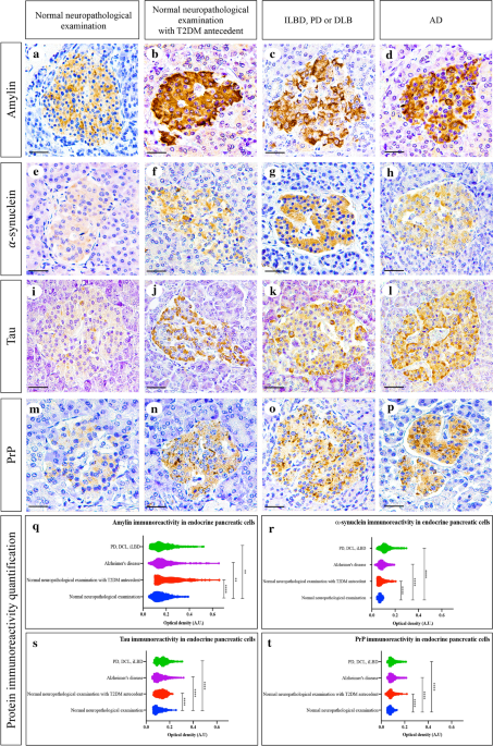 Mixed pathologies in pancreatic β cells from subjects with  neurodegenerative diseases and their interaction with prion protein | Acta  Neuropathologica Communications | Full Text