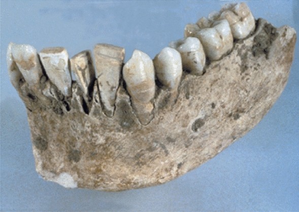 Moldable Teeth Tooth Rep Granules, Teeth Rep Kit, Diy Temporary Tooth Rep  Beads Tooth Rep